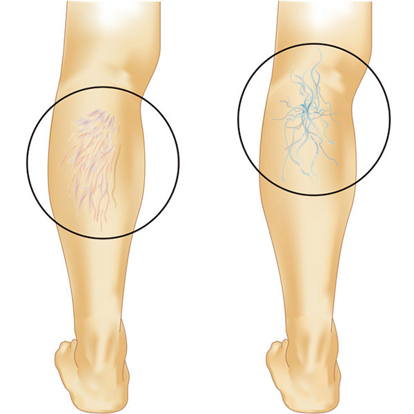 下肢静脈瘤について 大阪の下肢静脈瘤の治療なら梅田血管外科クリニック