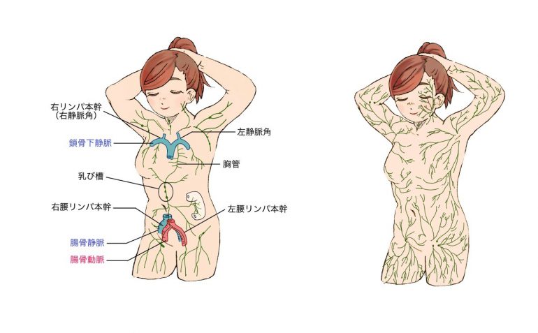リンパ浮腫の原因と症状と診断 大阪の梅田血管外科クリニック リンパ浮腫の原因と症状と診断 大阪の梅田血管外科クリニック