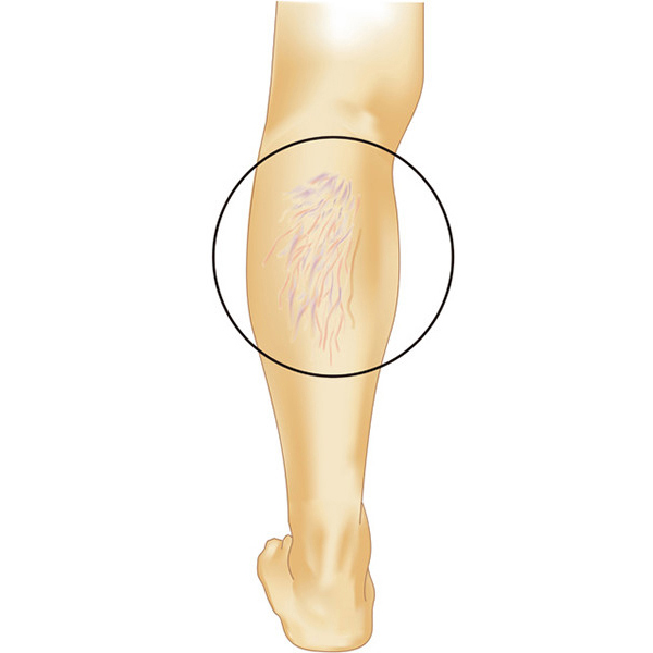 足の血管が見える、浮き出る【下肢静脈瘤】という病気についての治療や予防法 大阪市で下肢静脈瘤なら梅田血管外科クリニック