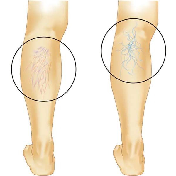 下肢静脈瘤